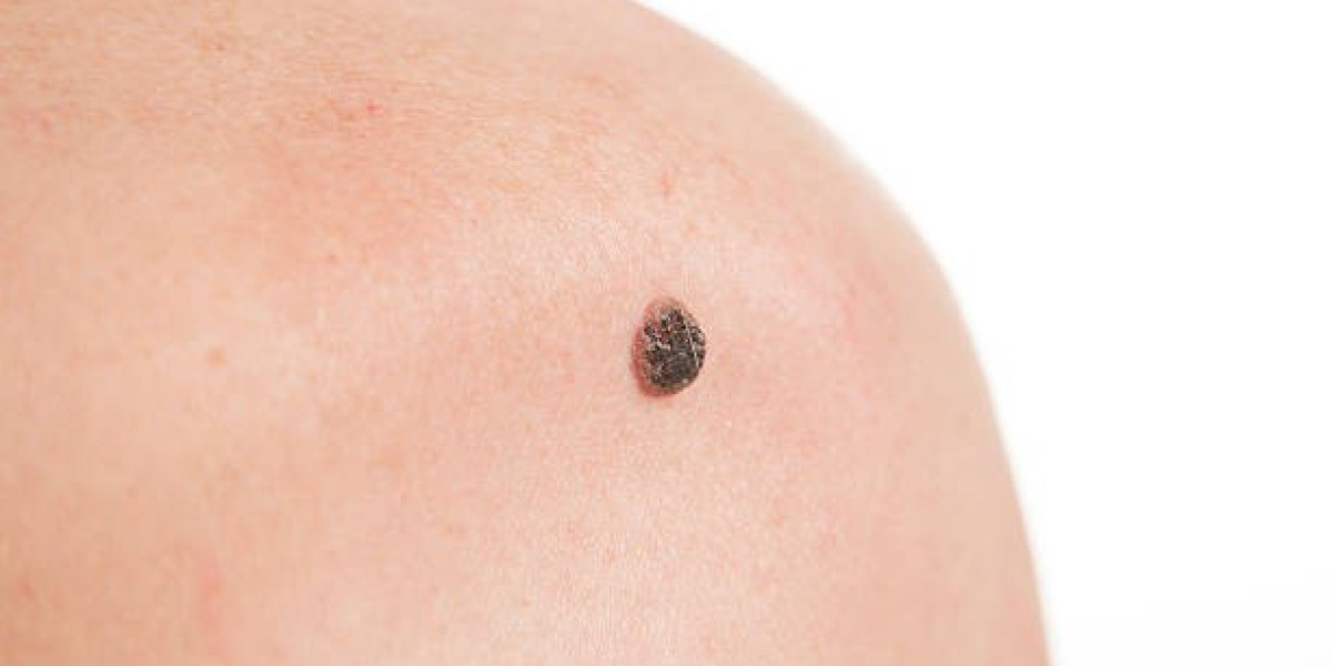 Wart Removal Techniques for Better Skin Appearance